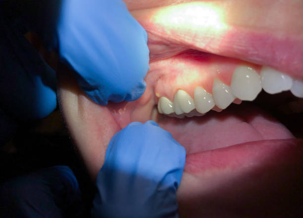 Best Emergency Tooth Extraction in Stockton, MO